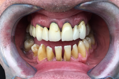 bridge-maxillaire-complet-dentiste-albert-01