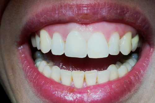 dentiste-jean-denis-albert-couronne-centrale-après