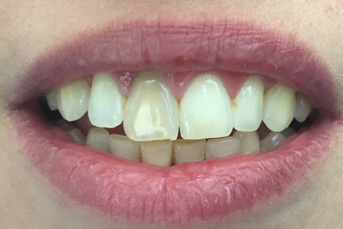 dentiste-jean-denis-albert-couronne-centrale-avant